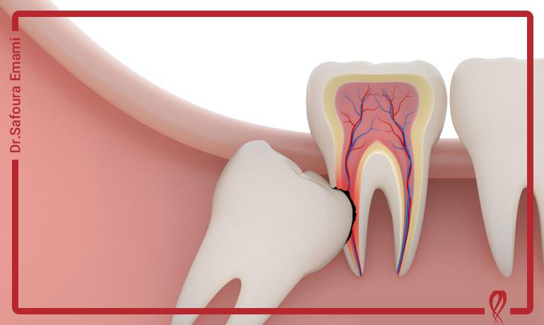 آیا ریشه دندان عقل قابل درمان است؟